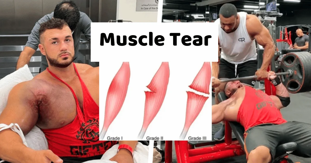 Muscle Tear - IC Fitness Club